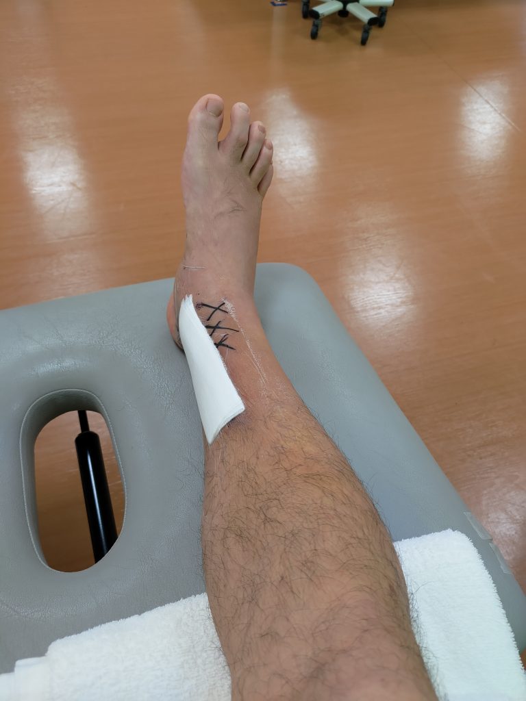 足の骨折、リハビリを終えた直後で浮腫みが引いている